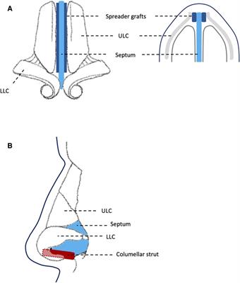 Functional septorhinoplasty alters brain structure and function: Neuroanatomical correlates of olfactory dysfunction